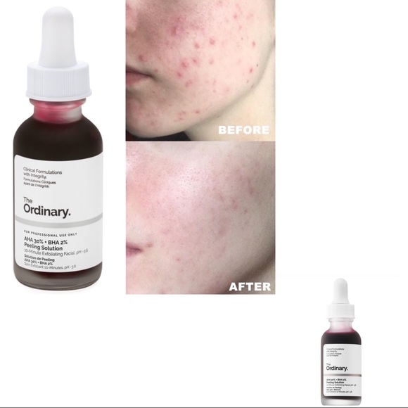 The Ordinary Other - 💙💙PEELING SOLUTION